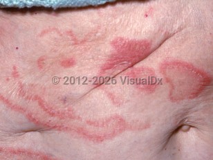 Clinical image of Erythema gyratum repens - imageId=2863184. Click to open in gallery.  caption: 'Annular, arcuate, and patterend erythematous plaques with overlying and trailing scale on the abdomen.'