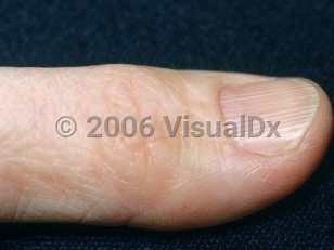 Clinical image of Longitudinal nail ridging - imageId=2882816. Click to open in gallery.  caption: 'Pronounced longitudinal ridges in the thumbnail.'