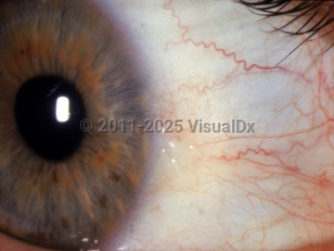Ophthalmic Imaging image of Pinguecula - imageId=2892787. Click to open in gallery. 