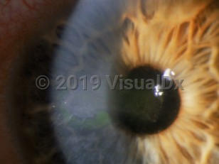 Ophthalmic Imaging image of Recurrent corneal erosion - imageId=2892800. Click to open in gallery. 