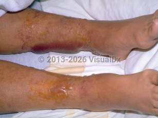 Vibrio vulnificus infection