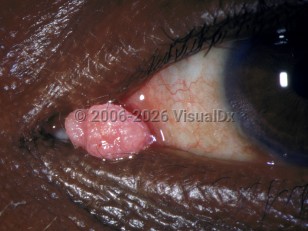 Ophthalmic Imaging image of Conjunctival papilloma - imageId=2912647. Click to open in gallery. 