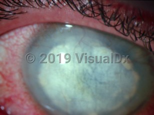 Ophthalmic Imaging image of Lipid keratopathy - imageId=2913037. Click to open in gallery.  caption: 'A cream-to-white discoloration in the corneal stroma interspersed with fine blood vessels.'