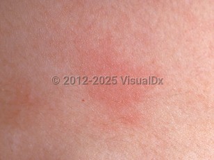 Cholinergic urticaria