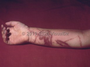Clinical image of Hawaiian box jellyfish sting - imageId=292476. Click to open in gallery.  caption: 'Linear and wavy, deeply violaceous plaques on the arm following a box jellyfish sting.'