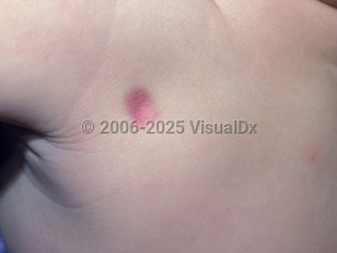 Clinical image of Medical procedure injury in utero - imageId=2929780. Click to open in gallery.  caption: 'A close-up of a pinkish papular scar.'