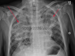 Herpes simplex virus pneumonia