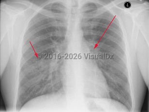 Tuberculosis