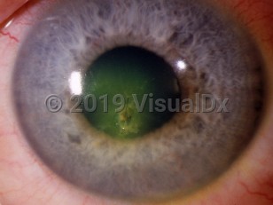 Ophthalmic Imaging image of Corneal foreign body - imageId=2985849. Click to open in gallery. 