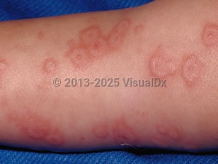 Clinical image of Erythema multiforme - imageId=30005. Click to open in gallery.  caption: 'Edematous and erythematous papules and plaques, some with a target-like appearance on the leg.'