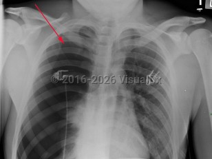 Spontaneous pneumothorax