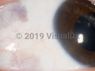 Ophthalmic Imaging image of Conjunctival melanosis - imageId=3071118. Click to open in gallery. 