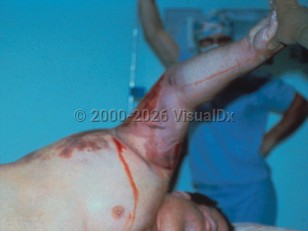 Gas gangrene