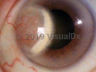 Ophthalmic Imaging image of Interstitial keratitis - imageId=3095395. Click to open in gallery. 