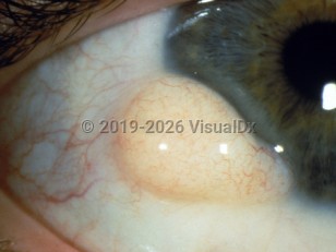 Ophthalmic Imaging image of Epibulbar dermoid cyst - imageId=3103756. Click to open in gallery.  caption: 'A yellowish-white, firm, rounded, fleshy papule at the limbus.'