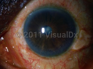 Ophthalmic Imaging image of Cataracts - imageId=3114289. Click to open in gallery.  caption: 'A blue-white discoloration in the pupillary space.'