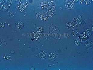 Lab image of Trichomoniasis - imageId=311490. Click to open in gallery.  caption: '<i>T vaginalis</i> seen on a wet mount (oval structure).'