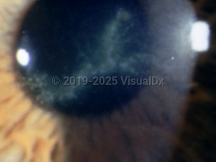 Ophthalmic Imaging image of Acanthamoeba keratitis - imageId=3119580. Click to open in gallery. 