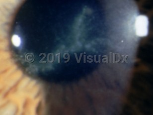 Ophthalmic Imaging image of Acanthamoeba keratitis - imageId=3119580. Click to open in gallery. 