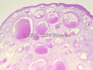 Lab image of Urethral caruncle - imageId=313343. Click to open in gallery. 