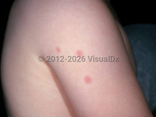 Clinical image of Bedbug bite - imageId=3133638. Click to open in gallery.  caption: 'Urticarial papules on the arm.'
