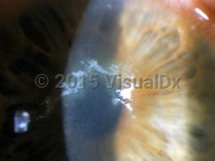 Ophthalmic Imaging image of Herpes zoster ophthalmicus - imageId=3149677. Click to open in gallery.  caption: 'Pseudodendrites on the cornea.'