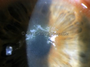 Herpes zoster ophthalmicus