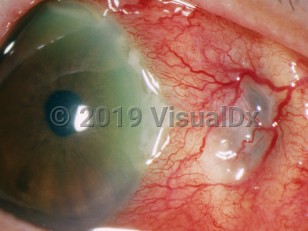 Ophthalmic Imaging image of Necrotizing scleritis - imageId=3158975. Click to open in gallery. 