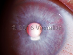 Ophthalmic Imaging image of Ocular albinism - imageId=3164160. Click to open in gallery. 