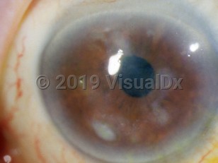 Ophthalmic Imaging image of Ocular acid burn - imageId=3171263. Click to open in gallery. 