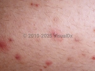 Folliculitis