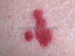 Clinical image of Vasculitis - imageId=323385. Click to open in gallery.  caption: 'A close-up of palpable purpura.'
