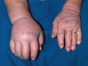 Lymphedema