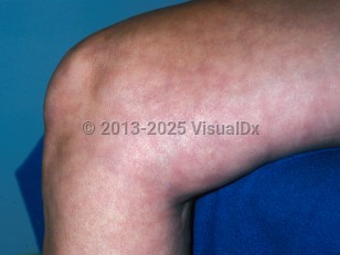 Clinical image of Livedo reticularis - imageId=327523. Click to open in gallery.  caption: 'Reticulate violaceous patches on the leg.'