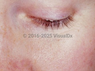 Clinical image of Seborrheic blepharitis - imageId=3275299. Click to open in gallery.  caption: 'Scaling at the eyelid margin.'