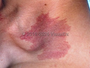 Clinical image of Port-wine stain - imageId=3351600. Click to open in gallery.  caption: 'A violaceous patch at the supraclavicular fossa.'
