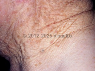 Clinical image of Solar elastosis - imageId=3358850. Click to open in gallery.  caption: 'Yellowish plaques with overlying linear, crisscrossing furrows on the posterior and lateral neck. Note also the actinic comedo (black papule).'