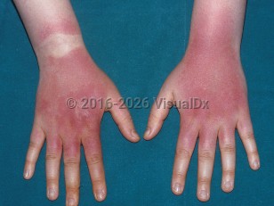 Clinical image of Drug-induced phototoxic reaction - imageId=337847. Click to open in gallery.  caption: 'Deep red patches and plaques on the dorsal wrists, hands, and fingers, sparing the area under the wristwatch, secondary to demeclocycline.'