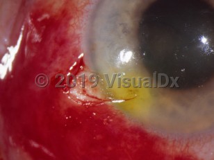 Ophthalmic Imaging image of Scleral laceration - imageId=3389882. Click to open in gallery. 