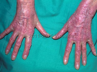 Drug-induced photoallergic reaction