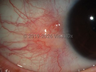 Ophthalmic Imaging image of Nodular scleritis - imageId=3511295. Click to open in gallery. 