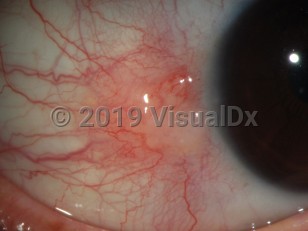 Ophthalmic Imaging image of Nodular scleritis - imageId=3511295. Click to open in gallery. 