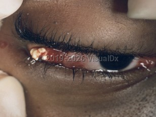 Clinical image of Lacrimal gland stones - imageId=3520439. Click to open in gallery.  caption: 'White material at the lateral eye with associated periorbital edema and conjunctival injection.'