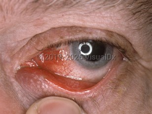 Clinical image of Canaliculitis - imageId=3520516. Click to open in gallery.  caption: 'Medial conjunctival injection, lower eyelid erythema, and a red, pouting punctum.&nbsp;'