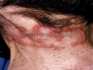 Clinical image of Elastosis perforans serpiginosa - imageId=35519. Click to open in gallery.  caption: 'Serpiginous, scaling, and crusted, erythematous plaques on the posterior neck.'
