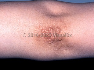 Clinical image of Tuberous xanthoma - imageId=356217. Click to open in gallery.  caption: 'Tuberoeruptive xanthomas showing yellowish and pinkish papules in a cluster on the elbow of a patient with familial type III hyperlipidemia.'