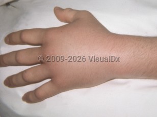 Clinical image of Lizard envenomation - imageId=3585332. Click to open in gallery.  caption: 'Marked edema and subtle erythema on the hand and wrist.'