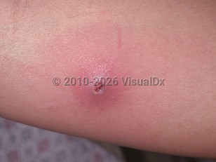 Clinical image of CA-MRSA skin infection - imageId=3667967. Click to open in gallery.  caption: 'A close-up of a furuncle with an overlying erosion.'