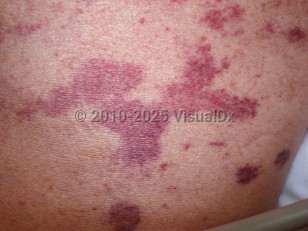 Clinical image of Strongyloidiasis - imageId=3671687. Click to open in gallery.  caption: 'A close-up of purpuric and ecchymotic patches in a patient with dermatomyositis, gram negative sepsis, and long term immunosuppression.'