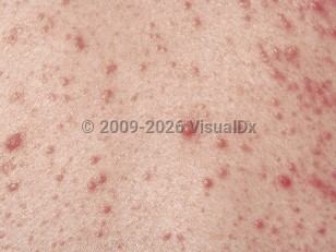 Clinical image of Neutrophilic eccrine hidradenitis - imageId=3839. Click to open in gallery.  caption: 'A close-up of showers of small erythematous papules.'